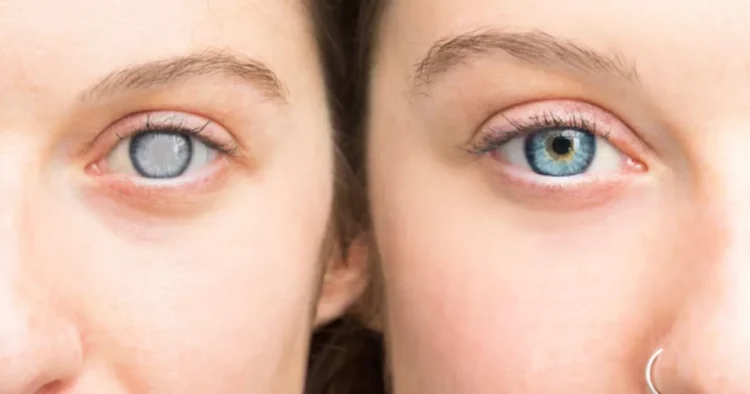 Kondisi Kebutaan Seseorang Karena Hilangnya Penglihatan